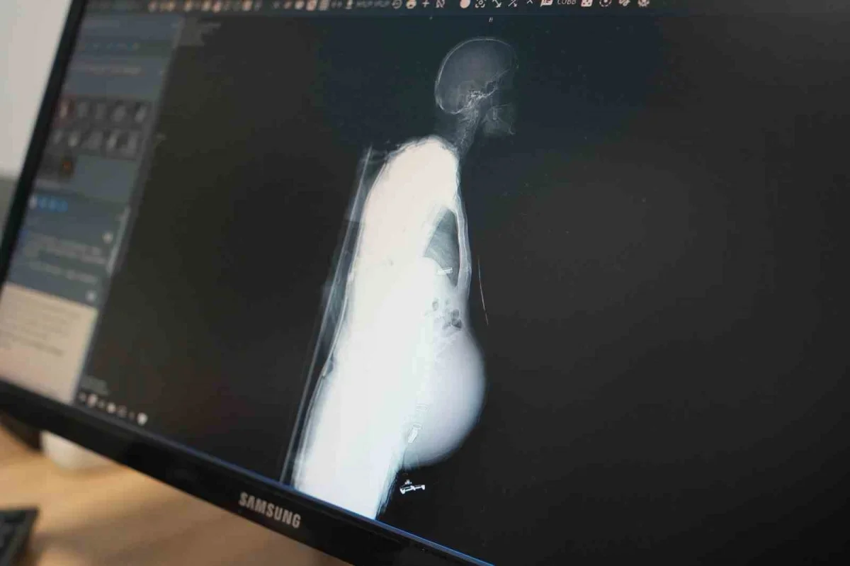 Kocaeli'de 6,5 kiloluk böbrek tümörü ameliyatla alındı