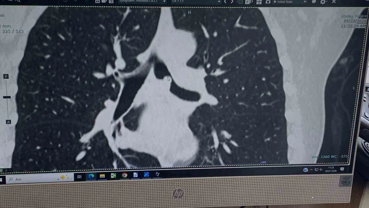 Kocaeli'de akciğer alınmadan tümörden kurtuldu