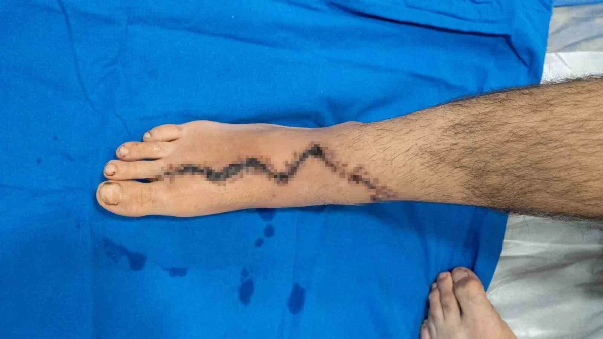 Avcılar'da 13 yaşındaki çocuğa ayaktan parmak nakli