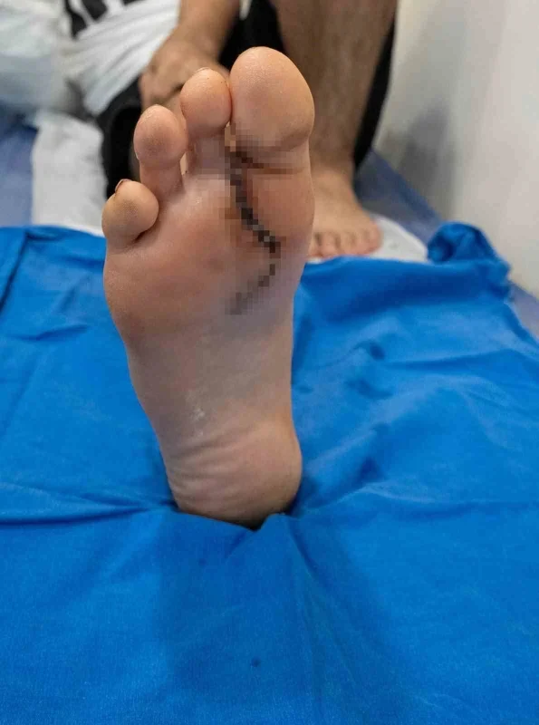 Avcılar'da 13 yaşındaki çocuğa ayaktan parmak nakli